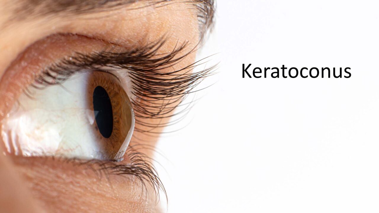 Keratoconus